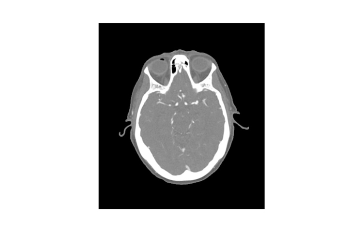 德國phantomx 50-03頭部CTA動脈瘤模體