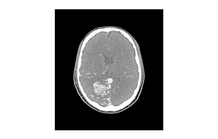 德國phantomx 50-04頭CTA AVM模體