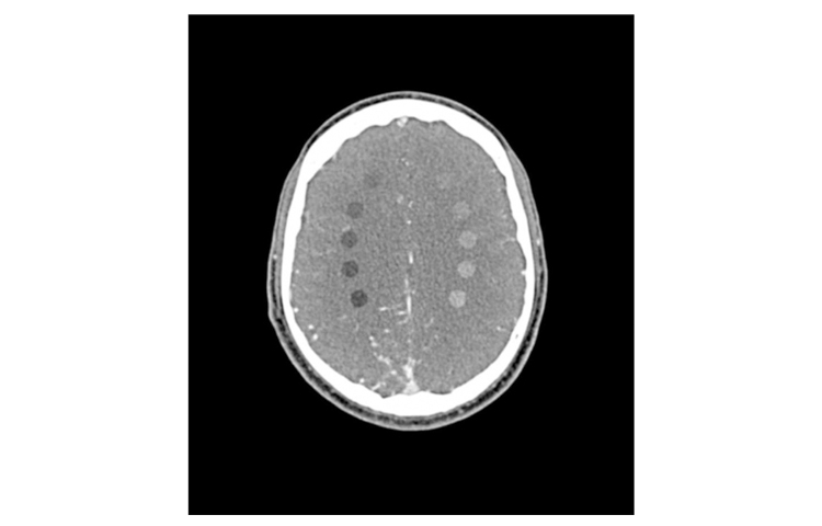 德國(guó)phantomx 50-04頭部CTA AVM/病變模體